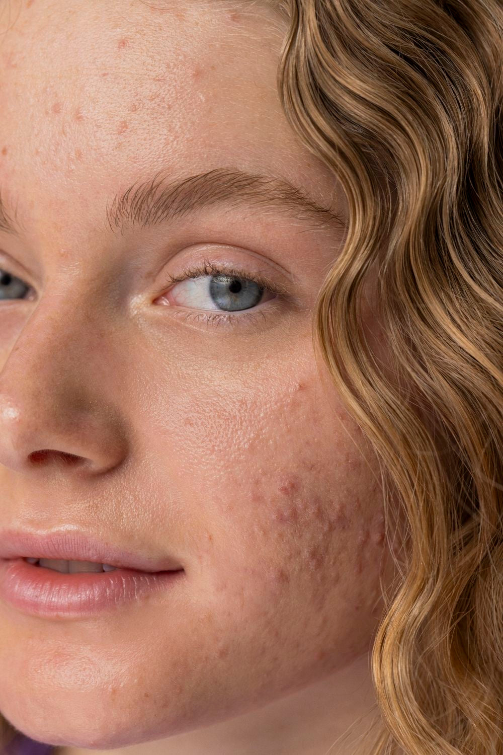 BioSkin Detox - Piel Acneica